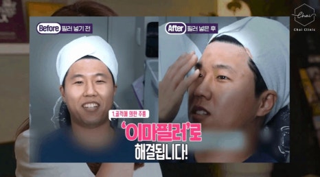 이마주름시술 필러와 보톡스만 있을까요? 관련 이미지 11