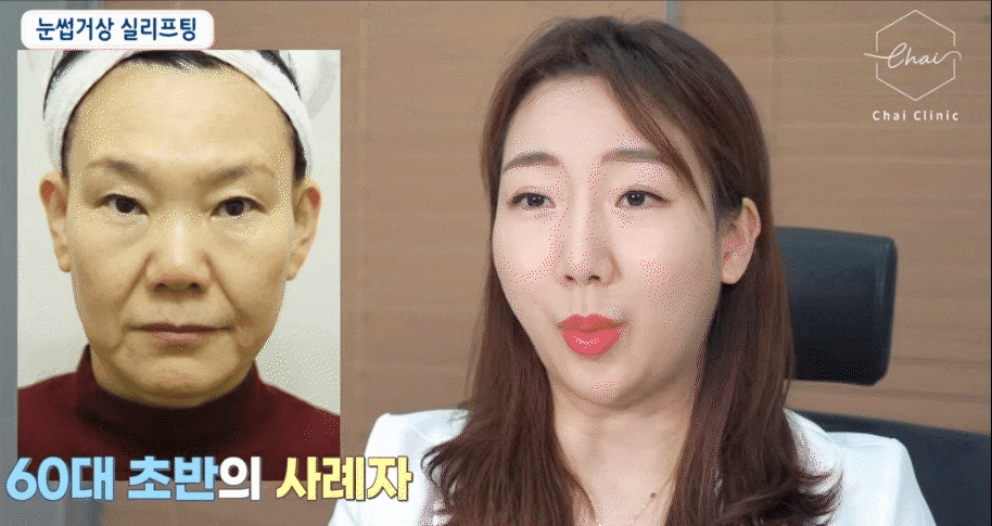 이마주름 리프팅 고민 ‘이것’ 잡으면 해결됩니다! 관련 이미지 8