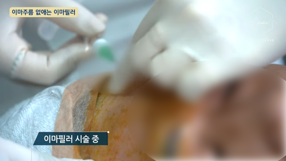 합정 보톡스 미간 이마 부작용 피하기 위해서는 관련 이미지 4