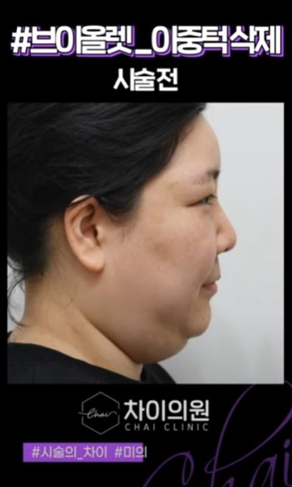 브이라인시술 매끄럽고 날렵한 라인으로! 관련 이미지 7