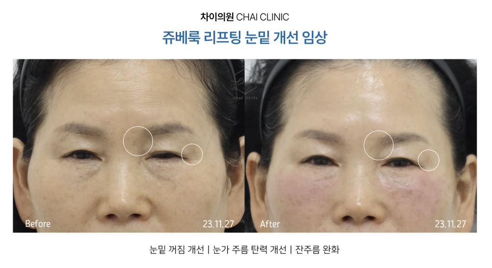 차이의원의 콜라겐 주사 종류 관련 이미지 2