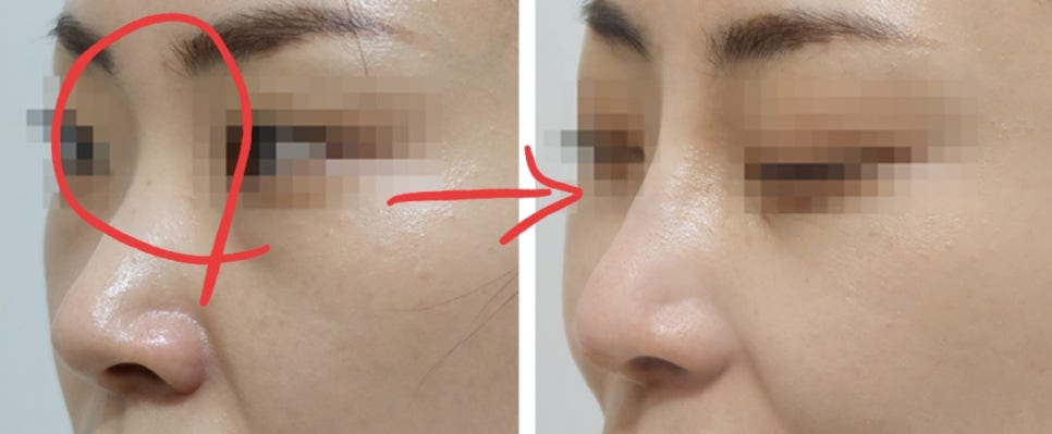 Hongdae Nose Filler Side Effects: Don’t Regret It — Get It Done Like This image 5