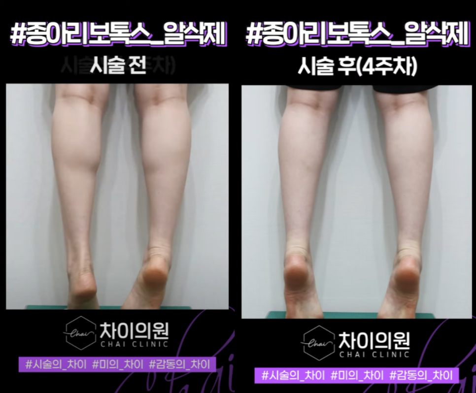 종아리알주사 부작용 없이 각선미 회복! 관련 이미지 9