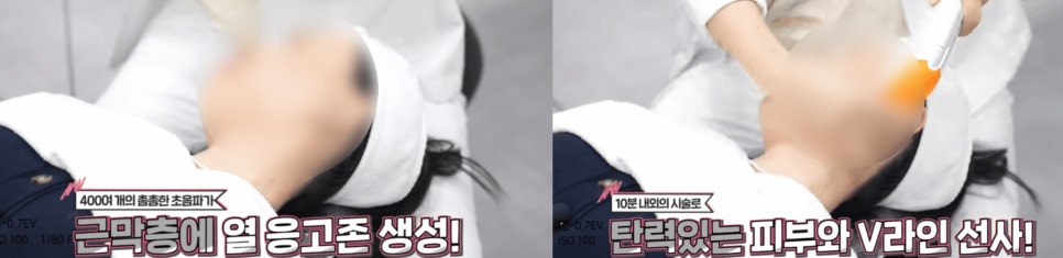 울쎄라슈링크? 축 처지는 피부를 위한 최적의 리프팅 관련 이미지 5