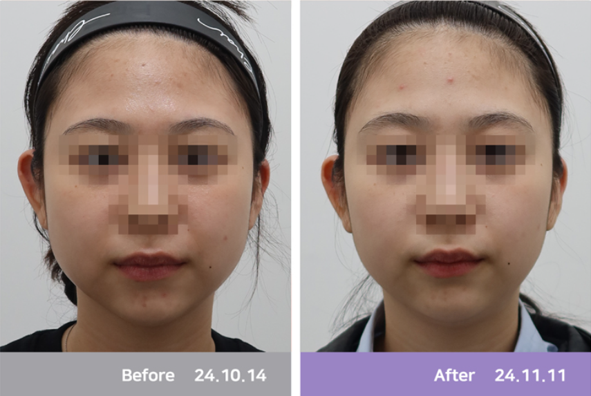 Hongdae Square Jaw Botox: Effects and How to Prevent Side Effects image 2