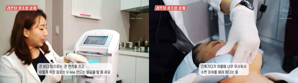 리프팅 레이저 종류 효과 이 글 하나로 정리 끝! 관련 이미지 4