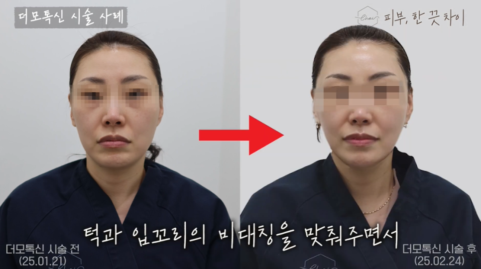 Two Things to Check Along with Hongik University Station Botox Prices image 5