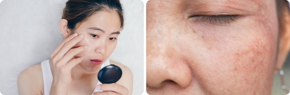 레이저토닝효과 제대로 보고 싶다면 ‘이것’ 중요합니다. 관련 이미지 5