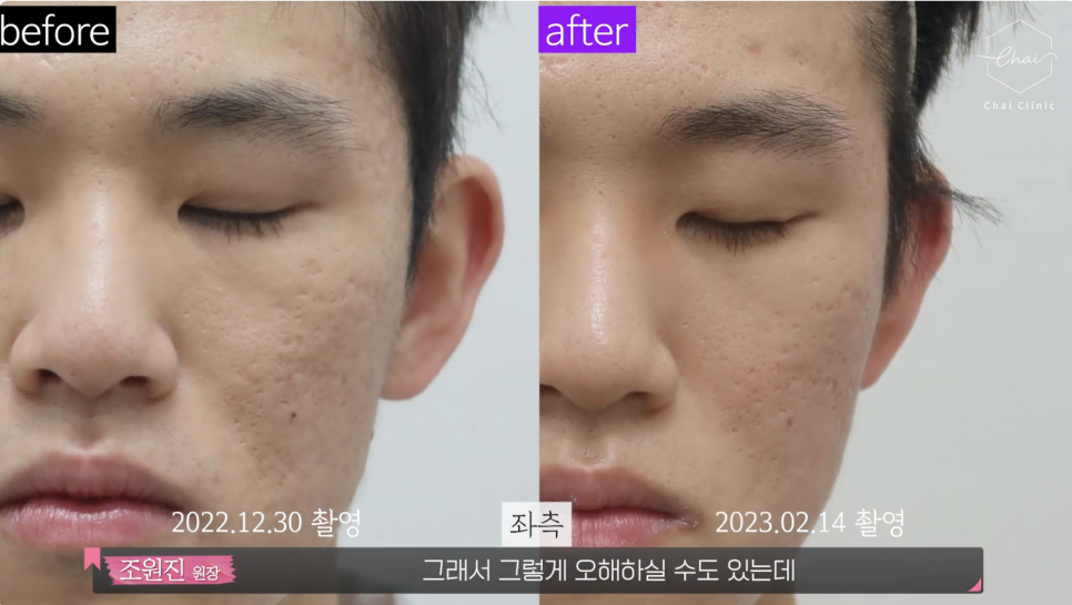 울퉁불퉁한 피부를 개선하는 쥬베룩 흉터 치료 관련 이미지 12
