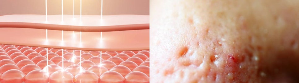볼모공 시술기기 비교, 피코프락셀 효과 관련 이미지 6