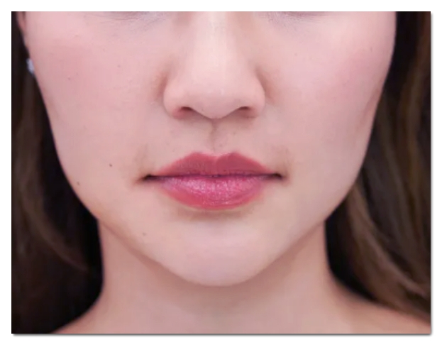 Why Can Improper Juvelook Volume Treatment Cause Bulging Jowls in Hongdae? image 2