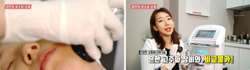 눈가 리프팅 탄력=기술력 어떻게 확인할까요?!😊 관련 이미지 8