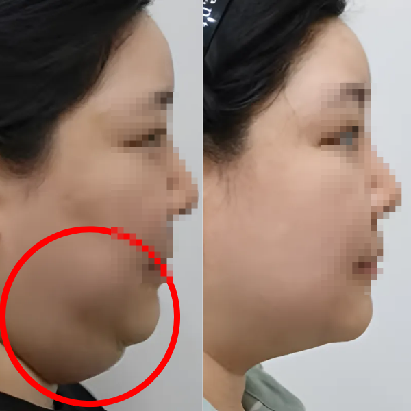 Why You Shouldn’t Get Contour Injections Anywhere in Hongdae image 4