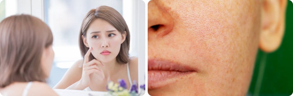 레이저토닝효과 제대로 보고 싶다면 ‘이것’ 중요합니다. 관련 이미지 8