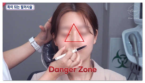 How to Consult So You Can Avoid Filler Side Effects in Hapjeong image 6