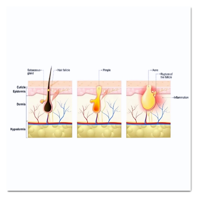 How to Get Acne Steroid Injections Effectively in Hongdae image 5