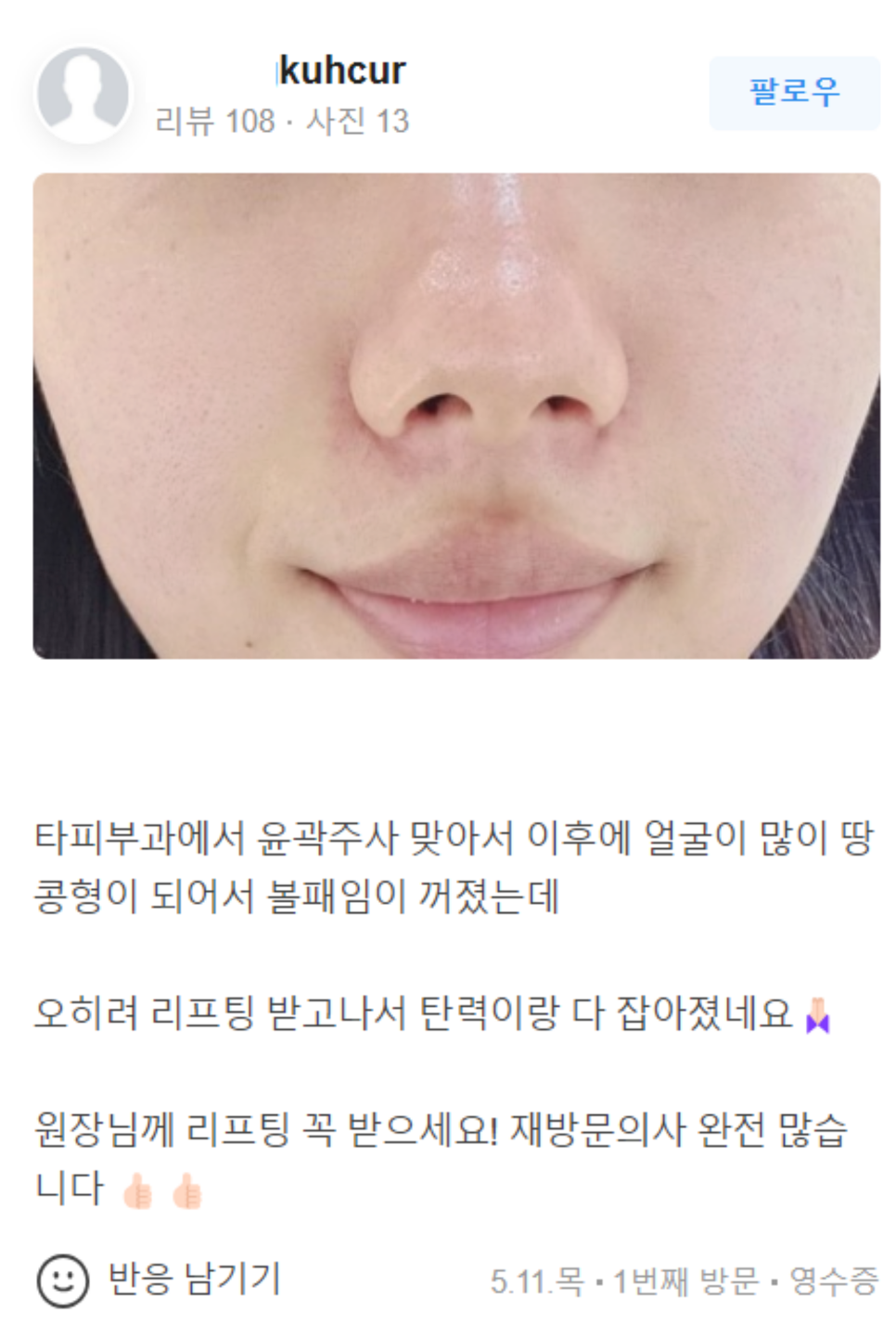 눈주름보톡스 관련 이미지 20