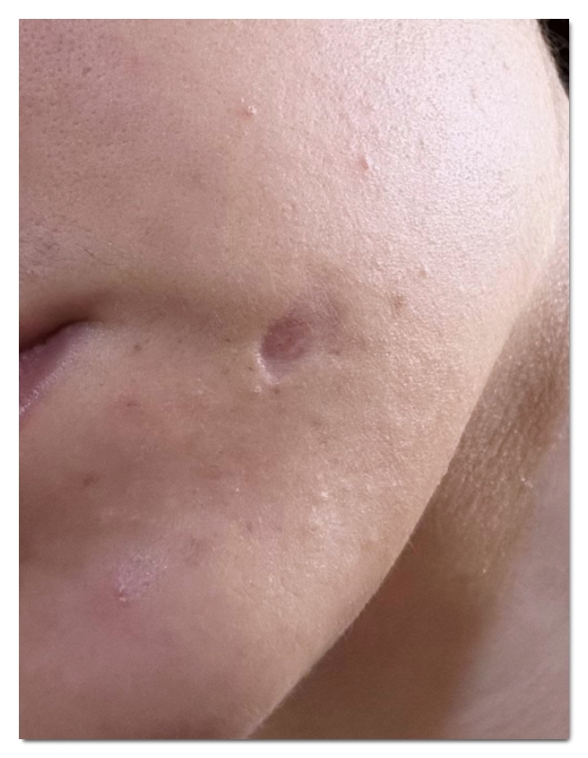 홍대 점제거 깨끗하게 빼기 위해서 알아야 할 3가지 관련 이미지 3