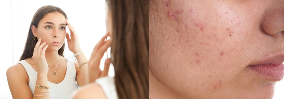 홍대여드름흉터 제거 가장 효과적인 제거 방법은? 관련 이미지 4