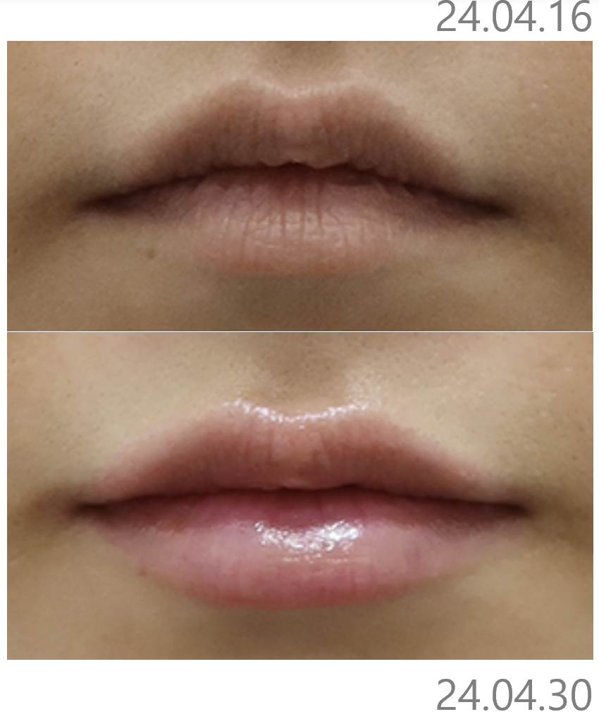 Lip Filler 1cc Before and After: Pain, Duration, and Precautions image 4