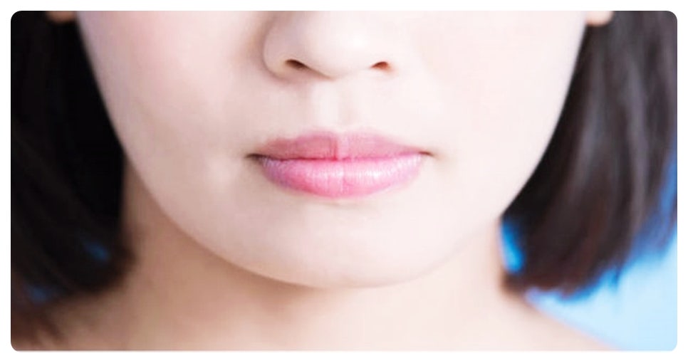 홍대턱보톡스 효과적인 급찐급빠 얼굴 다이어트 관련 이미지 4
