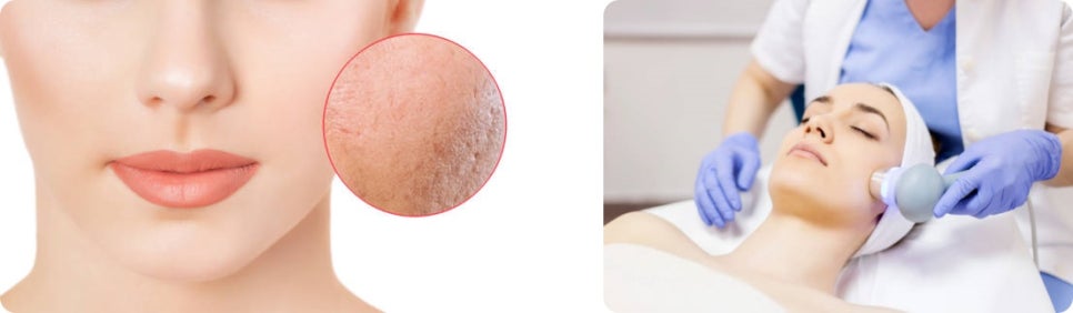 피코레이저 가격, 색소침착을 효과적으로 개선 하고 싶다면 관련 이미지 7