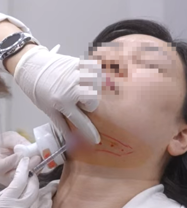How to Get Contour Injections for Buccal Fat and Double Chin in Hongdae image 4