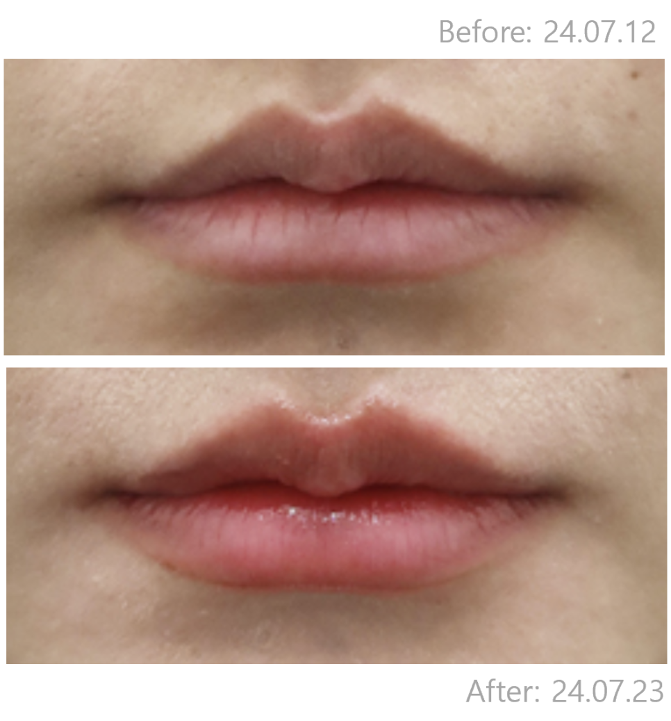 Hongdae Lip Filler: A Complete Guide to Pain, Swelling, and Design Before and After image 5