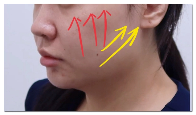 합정 울쎄라 팔자주름 심부볼은 이렇게 맞으세요 3가지 방법 관련 이미지 5