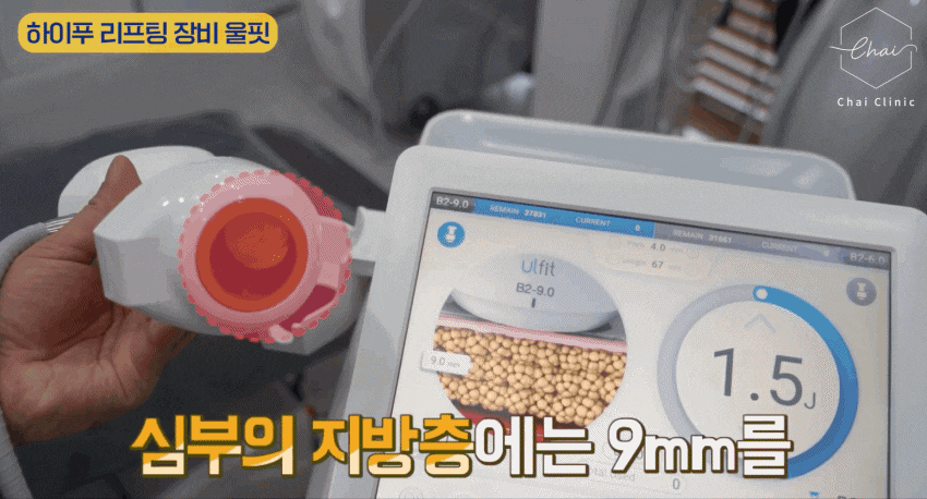 셀룰라이트주사 고민하는 지금이 가장 최적기 관련 이미지 7