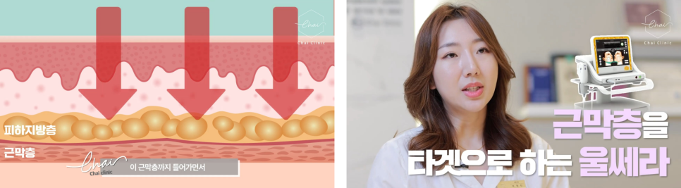 울써마지 가격, 피부전문의가 솔직하게 말씀드립니다 관련 이미지 7