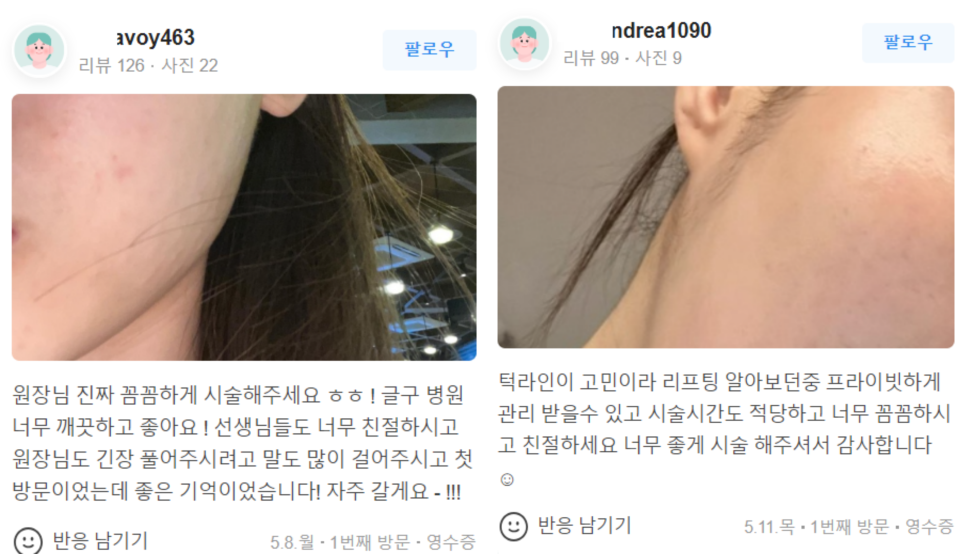 볼꺼짐필러, 자연스럽게 얼굴 볼륨을 높이는 비결 관련 이미지 12