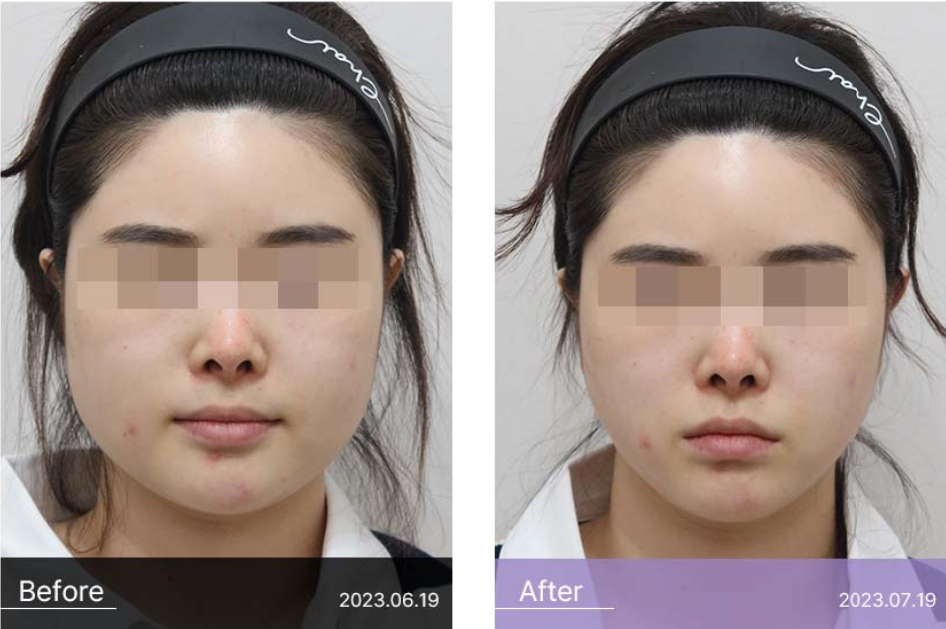 Hongdae Square Jaw Botox: Effects and How to Prevent Side Effects image 5