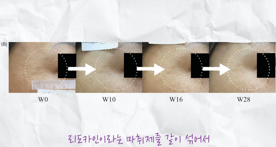 리쥬란 hb 효과, 유지기간, 통증 총정리! 관련 이미지 2