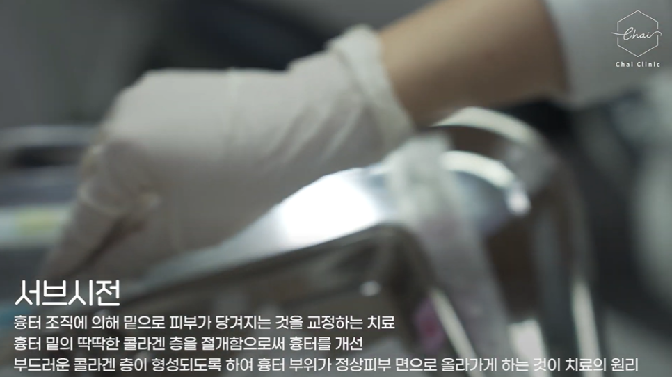 여드름흉터 시술 유형별로 달라야 하는 까닭은? 관련 이미지 5