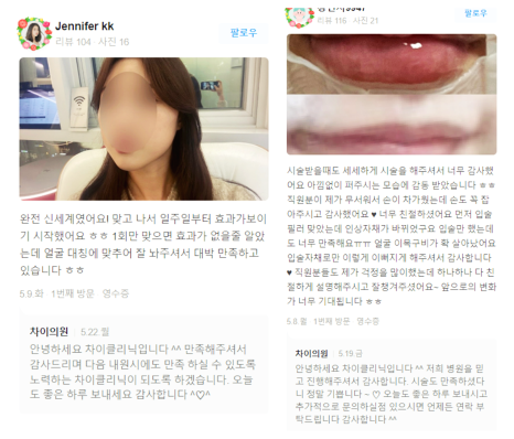 관자놀이보톡스 큰바위얼굴 고민해결 관련 이미지 14