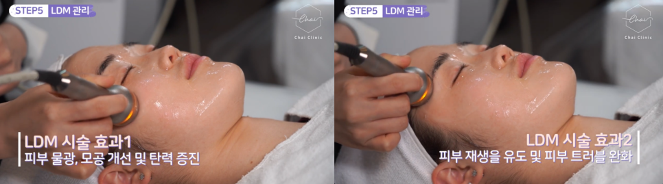 LDM물방울리프팅 효과 수분은 물론 탄력까지 찾아드려요 관련 이미지 3