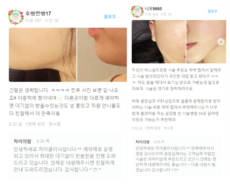 관자놀이보톡스 큰바위얼굴 고민해결 관련 이미지 16