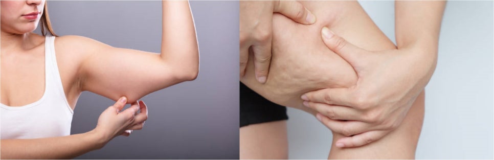 바디지방분해주사 이렇게 맞아야 효과 볼 수 있어요 관련 이미지 4
