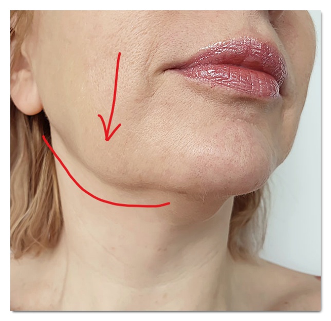 Hongdae Jaw Botox: A Complete Guide to Side Effects That Can Occur While Reducing Jaw Muscles image 5