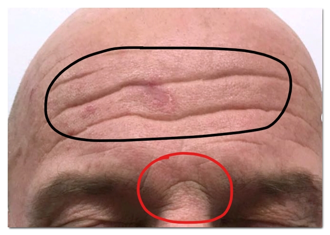 홍대 이마보톡스 미간이랑 같이 효과적으로 맞는 방법 관련 이미지 4