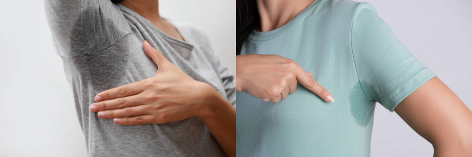 겨드랑이보톡스 다한증 치료에 효과적! 관련 이미지 12