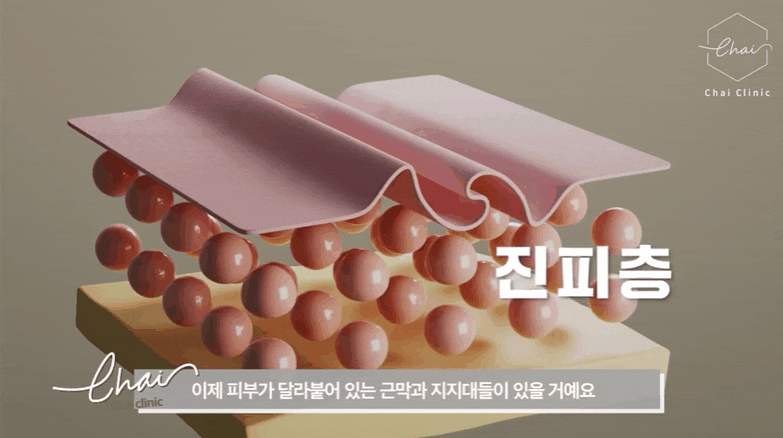 홍대피부관리 떨어지는 피부 탄력 확실하게 리프팅 하는 비결 (근처10분거리) 관련 이미지 6