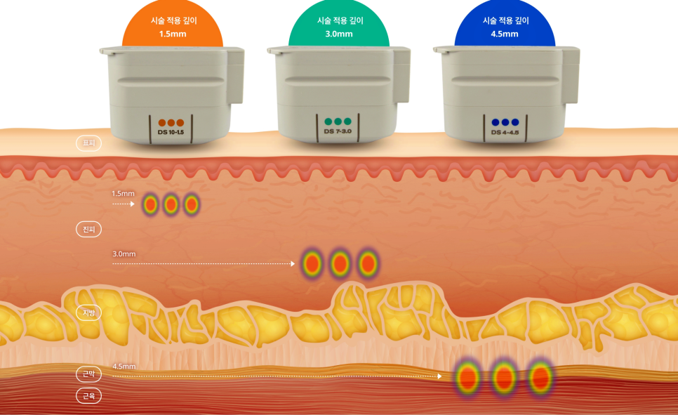 울쎄라 효과시기 제대로 보려면 &lsquo;이것&rsquo; 중요합니다 관련 이미지 10