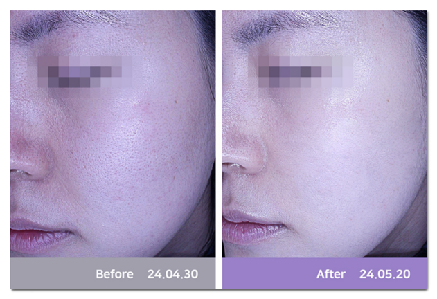 Why People Say Rejuran Is Ineffective Without Embossing image 5