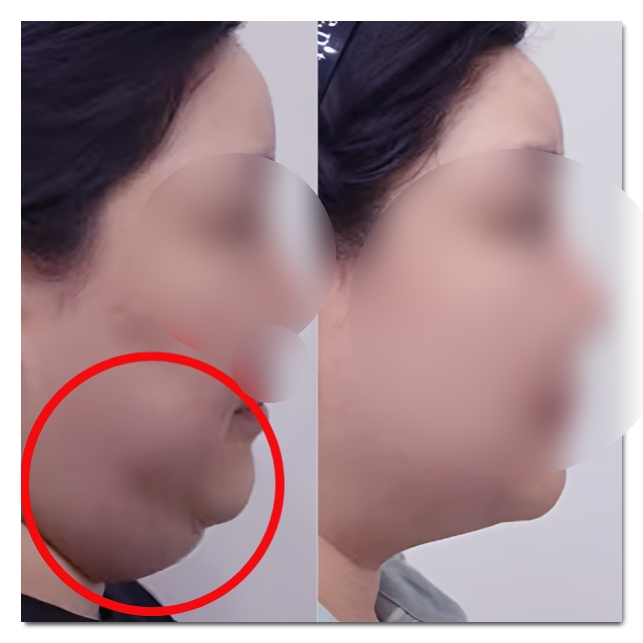 홍대 지방분해주사 복부, 팔뚝, 이중턱 시술 결과는? 관련 이미지 6