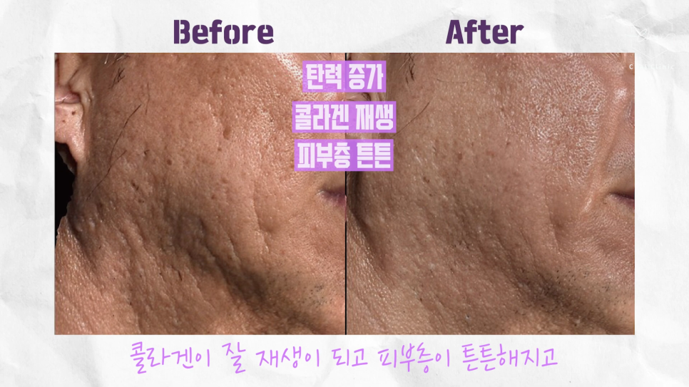합정 필러 콜라겐 주사 차이점과 효과는? 관련 이미지 4