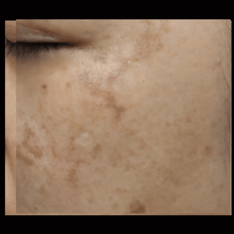 If You Don’t Want to Waste Money on Hongdae Pico Toning, Look at These 3 Things image 5