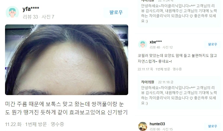 처진볼살리프팅 관련 이미지 15