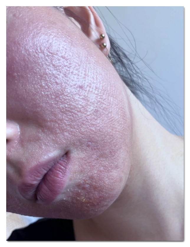 홍대 포텐자 모공 제대로 조이려면 이 2가지는 꼭 보세요 관련 이미지 8